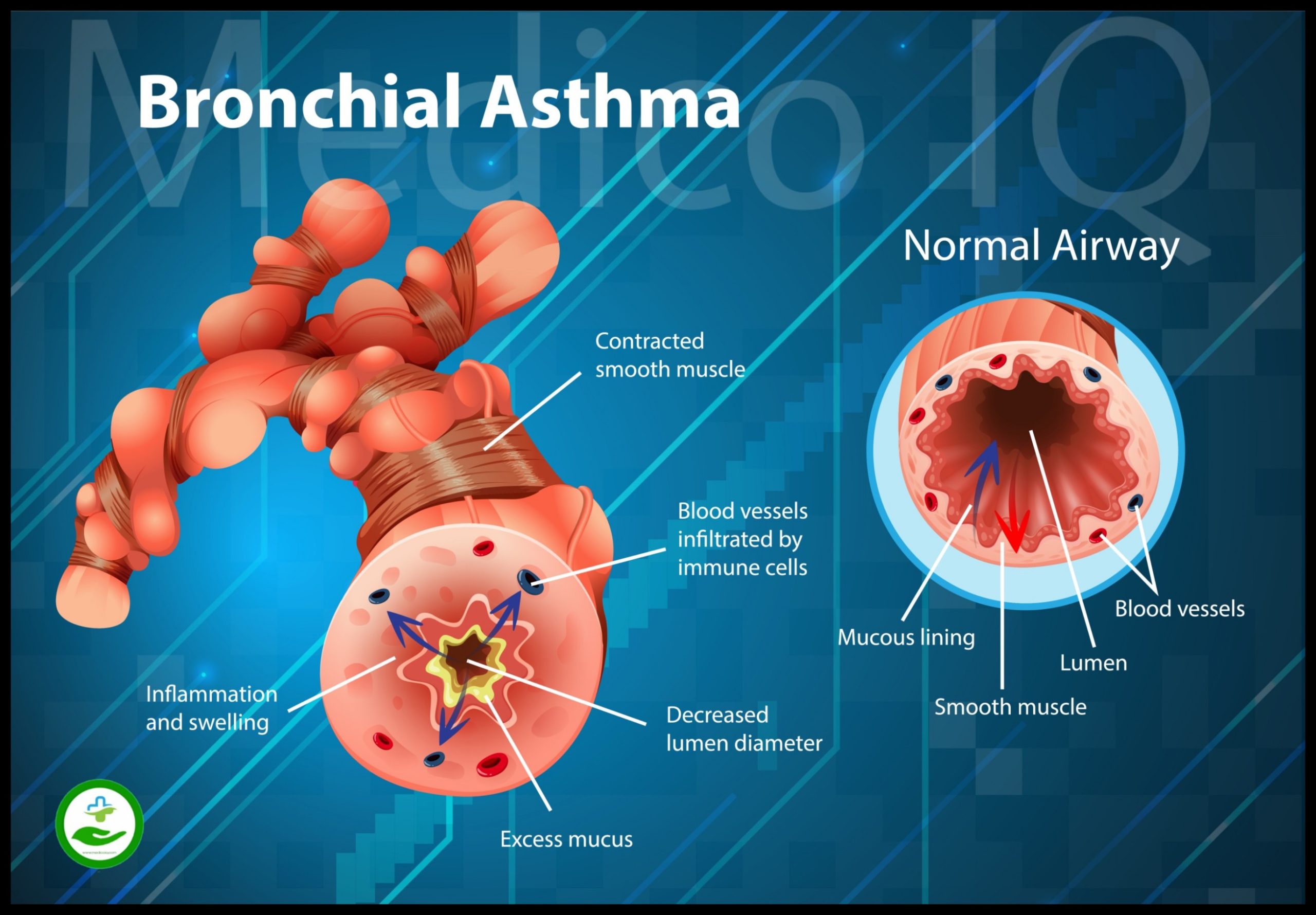 Asthma Pathophysiology ,Symptoms, Causes & Treatment